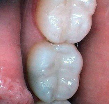 fillings-after1